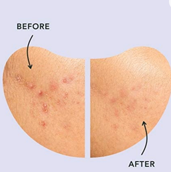 💙 4/$20 Miracle Patch Spot Control - Picture 3 of 5